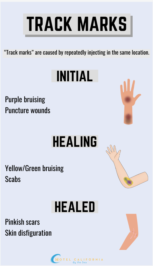 Infograph showing the different signs of track marks from drug use and drug injection.