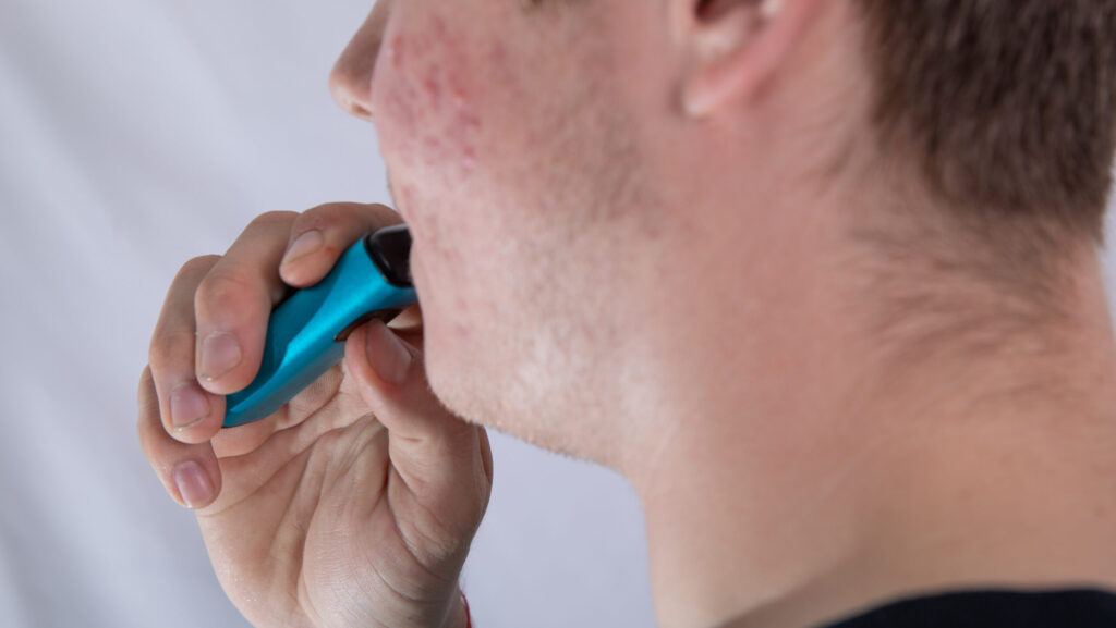 A young man with acne using a vaping device shows there may be a correlation between vaping and acne.